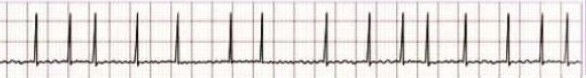 Atrial fibrillation