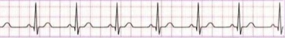 Normal ECG