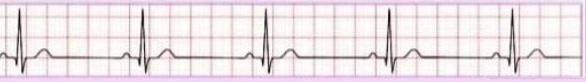 Sinus bradycardia