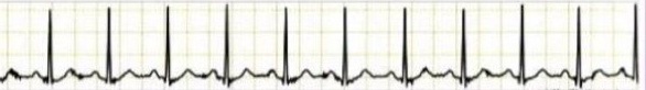 Sinus tachycardia