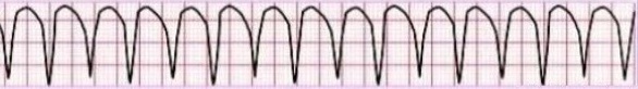 Ventricular tachycardia